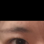 쌍수 <b>재수술</b> 각임?