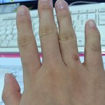 손가락위에 빨간혹이 생겼어요..티눈인가요?<b>사마귀</b>인가요?정체가 뭔가요?
