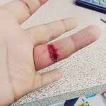 <b>한때</b>유행했던 상처만들기