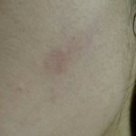 [피부] 이거 <b>화농성</b> 여드름 나려고하는거야?