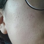 [댓글부탁해] 이런여드름은 어케없애?ㅠㅜ