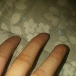 손에 <b>물집</b>같은거 이거뭐야?