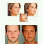 [댓글부탁해] 서양인들 턱성형