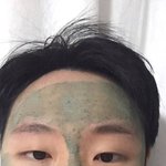[앞트임] 남잔데 수술 할까말까 (사진ㅇ)