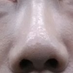 [개깊은빡침] 이거 필러 부작용입니까. 기다리면 나아진다고 해서...