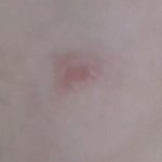 [댓글부탁해] 다이소여드름<b>패치</b>떼고 어떡해?(약혐..?인가)