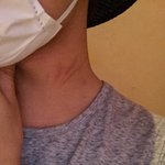 [댓글부탁해] 사진)이거 몸에 갑자기 생겼는데 뭐같음?