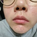 여드름<b>자국</b> 없어져?