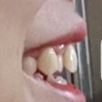 [댓글부탁해] <b>덧니</b> 평가좀