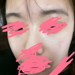 [꼭조언부탁] 피부 고민 상담부탁드려요!