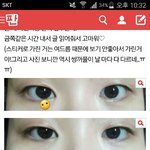 김)  자세한 쌍수후기