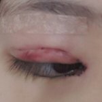 [댓글부탁해] <b>쌍수후</b> 멍이 빨개짐ㅠㅠㅈㅂ