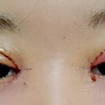 쌍수 망한건가요ㅠㅠㅠㅠ?????
