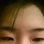 [댓글부탁해] <b>비절개</b>눈매교정 할까말까 사진유