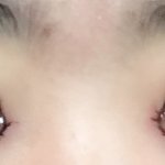 [댓글부탁해] [<b>눈갱</b> 주의]쌍수 2일째