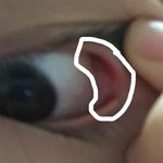 다래끼 초기증상 뭐야?ㅜㅜㅜ