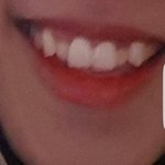 [댓글부탁해] <b>덧니</b>어때?