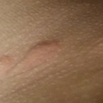 [꼭조언부탁] 조리원다녀온뒤 벌레물린<b>자국</b>과 벌레알레르기...