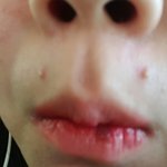 이거 <b>여드름</b>이야??