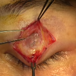 [EXO] 안검<b>하수</b> 수술ㄷㄷ