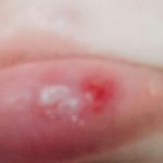 [댓글부탁해] 입술에 <b>물집</b>? 같은거 (입술주의)