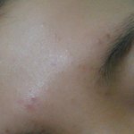 [조언부탁해] 혐주의)<b>좁쌀</b>여드름?없애는법아는사람ㅜㅜㅜㅠ