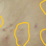 [댓글부탁해] 여드름 <b>흉터</b> 연고 추천 좀ㅠㅅㅠ- 약혐주의