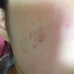 피부과가서 여드름 <b>흉터</b> 없애본사람 있어??