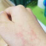 [댓글부탁해] 나 화상입은거임..?