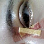 [꼭댓글부탁] 쌍수<b>실밥</b>풀기전에 붓기빠지면