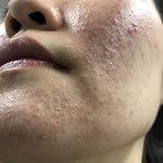 [<b>방</b>탈죄송] 피부때문에 너무 힘들어요 ㅠㅠ 도와주세요 (혐오스러워요)