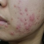 여드름 <b>박멸</b>시킨 노하우&amp;후기