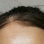 [EXO] 2달동안 블랙헤드,<b>여드름</b> 없애는 방법알려줌