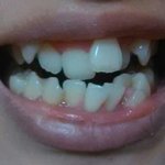 [조언부탁해] +마지막 추가)치아 나어떡하니