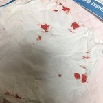 얘들아 나 눈에서 <b>피나</b>..