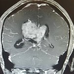 [꼭봐주세요] 23살 이제 앞이 보이지않습니다.