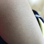 너네도 인<b>그로운</b> 헤어 있어? 사진 혐