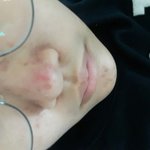 [조언부탁해] <b>코에</b> 피지랑 블랙헤드 짜다가 완전 빨개지고 상처난...