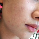 (방탈죄송&amp;혐짤주의)여드름땜에 미치겠어요 제발좀 도와주세요ㅠㅠ