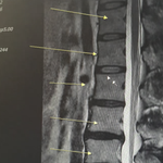 다발성 허리다스크 치료
