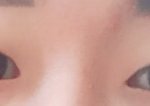<b>심심</b>해서 쓰는 쌍수후기ㅋㅋㅋ