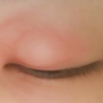 [조언부탁해] <b>염증</b>?주의)애들아 나눈이 안떠져