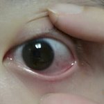 렌즈 땜에 눈 <b>충혈</b>됨..