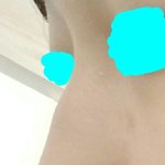 매<b>부리</b>코 수술할까