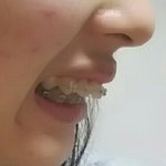 [댓글부탁해] 내가 <b>앞니</b>가 튀어나와서 교정기꼈거든