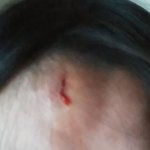 [댓글부탁해] (혐오) 이거 <b>이마</b>찢여진거야?