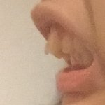 [댓글부탁해] 나 부정<b>교합</b> 조카심함 씨바ㅋㅋㅋ 혐주의