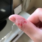 나처럼 <b>손</b> 살 뜯는 버릇 있는<b>사람</b> 있냐 (혐오주의)