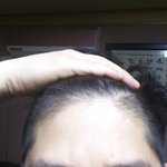 [알려주세요] <b>이마</b> 라인 미치겠어요 ㅠ