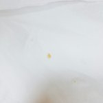 <b>편도</b>결석 뺐다